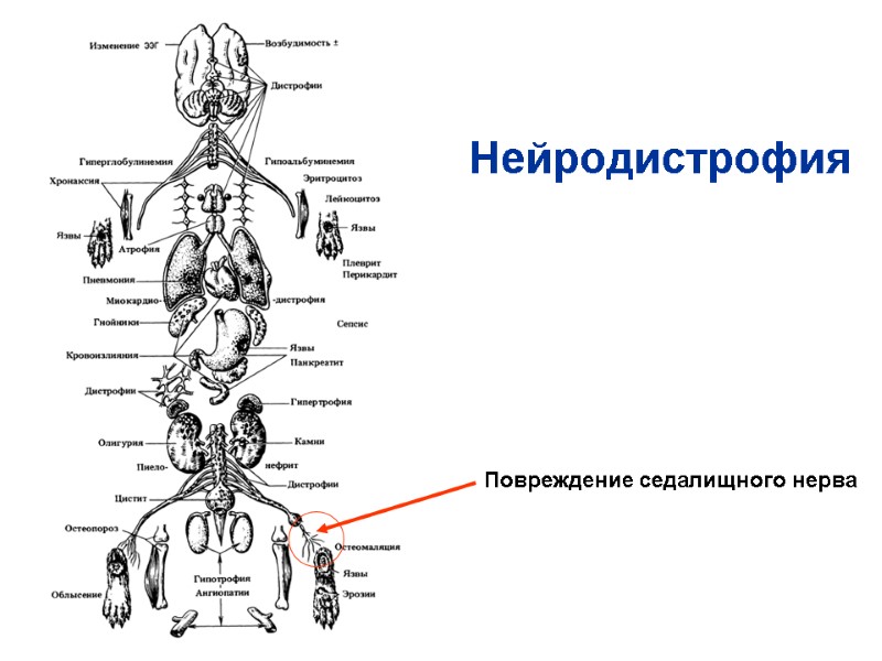 Нейродистрофия Повреждение седалищного нерва